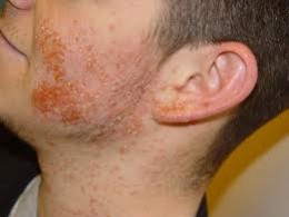 staph infection